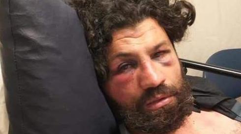 תושב מזרח ירושלים טוען: הותקפתי כי דיברתי בערבית