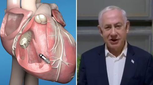 מתי נדרשת השתלת קוצב לב - ומה מיוחד בזה של נתניהו? | כל התשובות